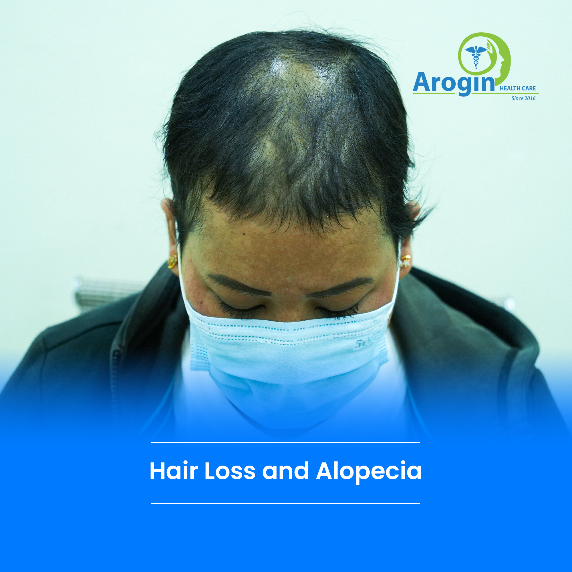 Understanding Hair Loss and Alopecia: Causes and Treatment Options