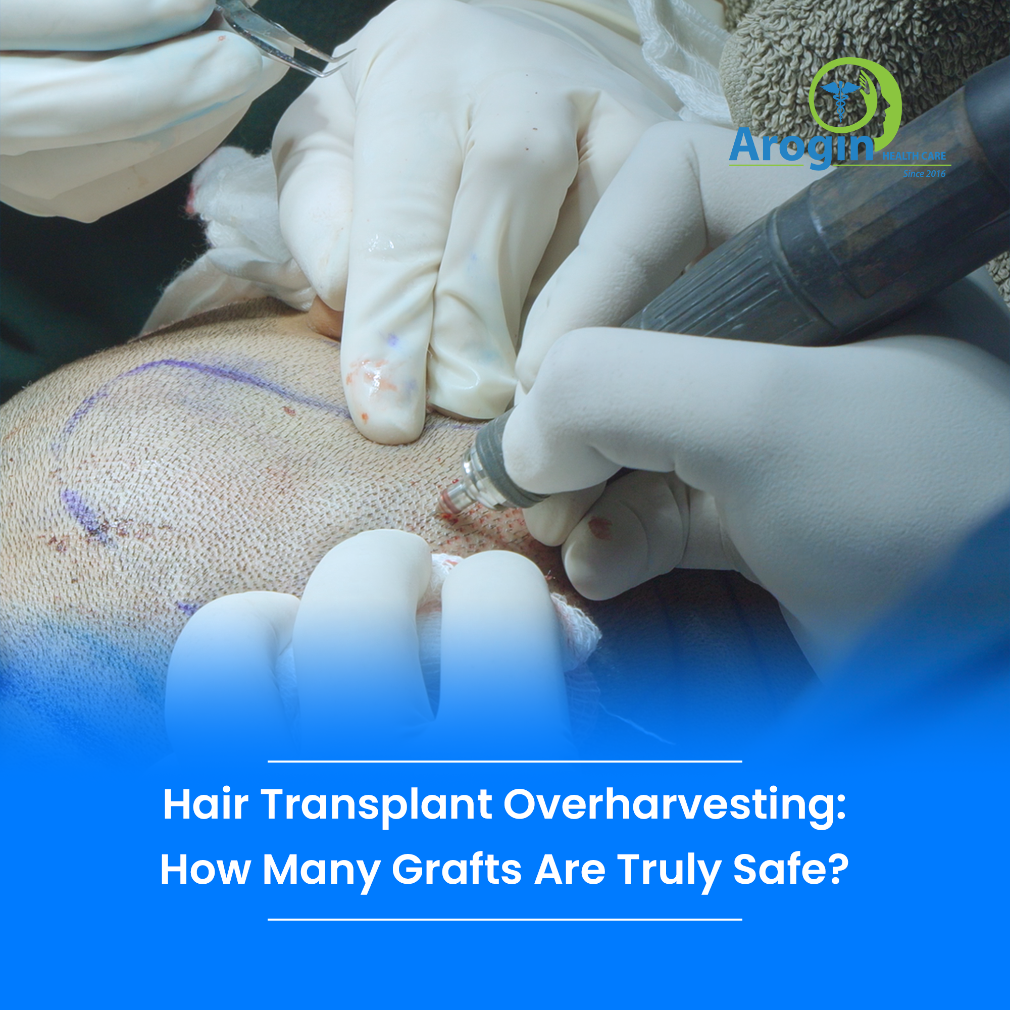 Hair Transplant Overharvesting: How Many Grafts Are Truly Safe?