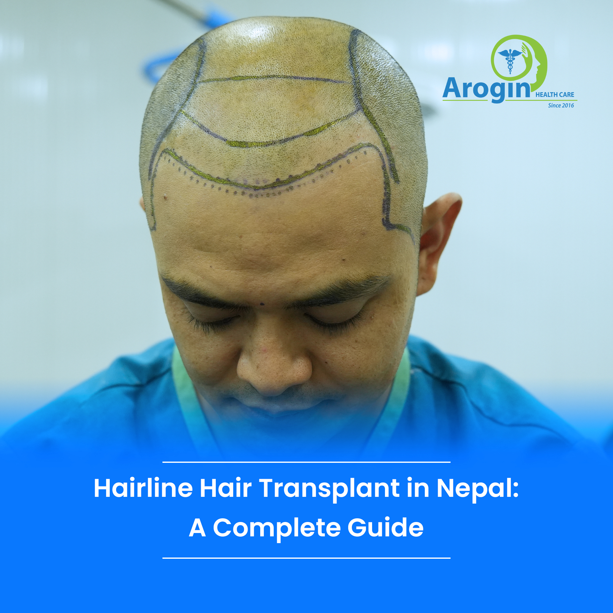 Hairline Hair Transplant in Nepal: A Complete Guide