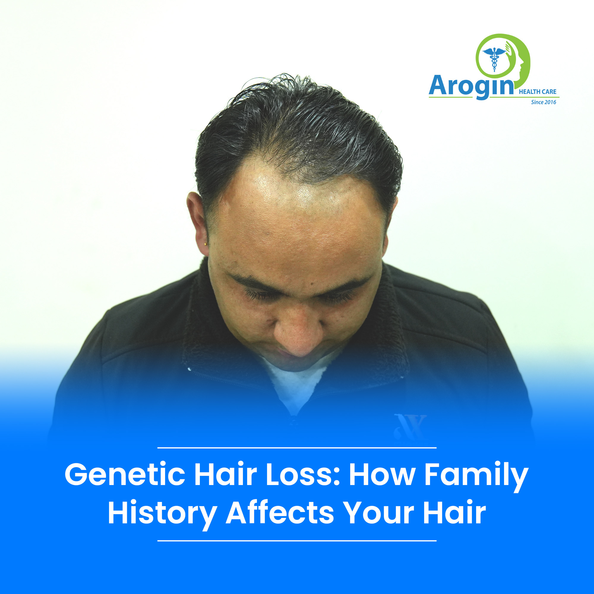 Genetic Hair Loss: How Family History Affects Your Hair