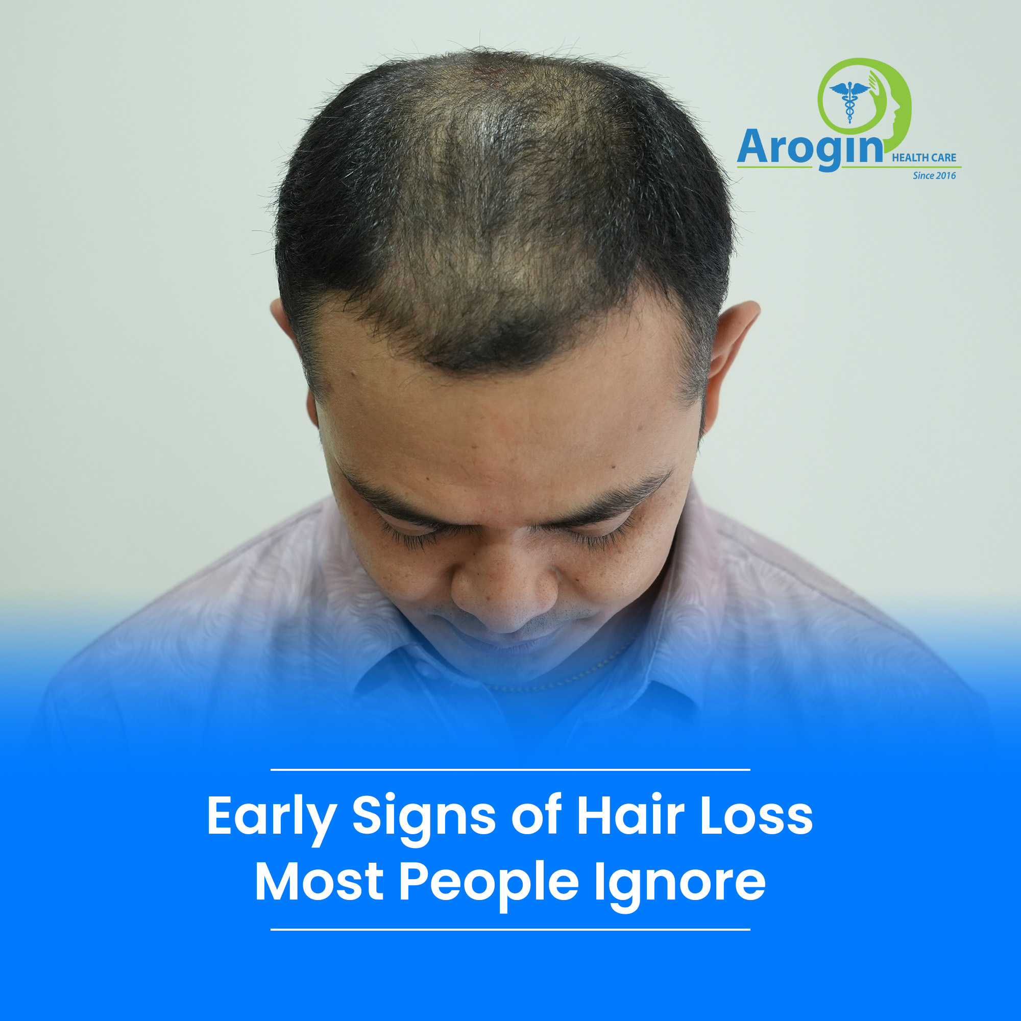 Early Signs of Hair Loss Most People Miss