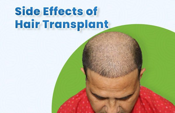 Side Effects of Hair Transplant