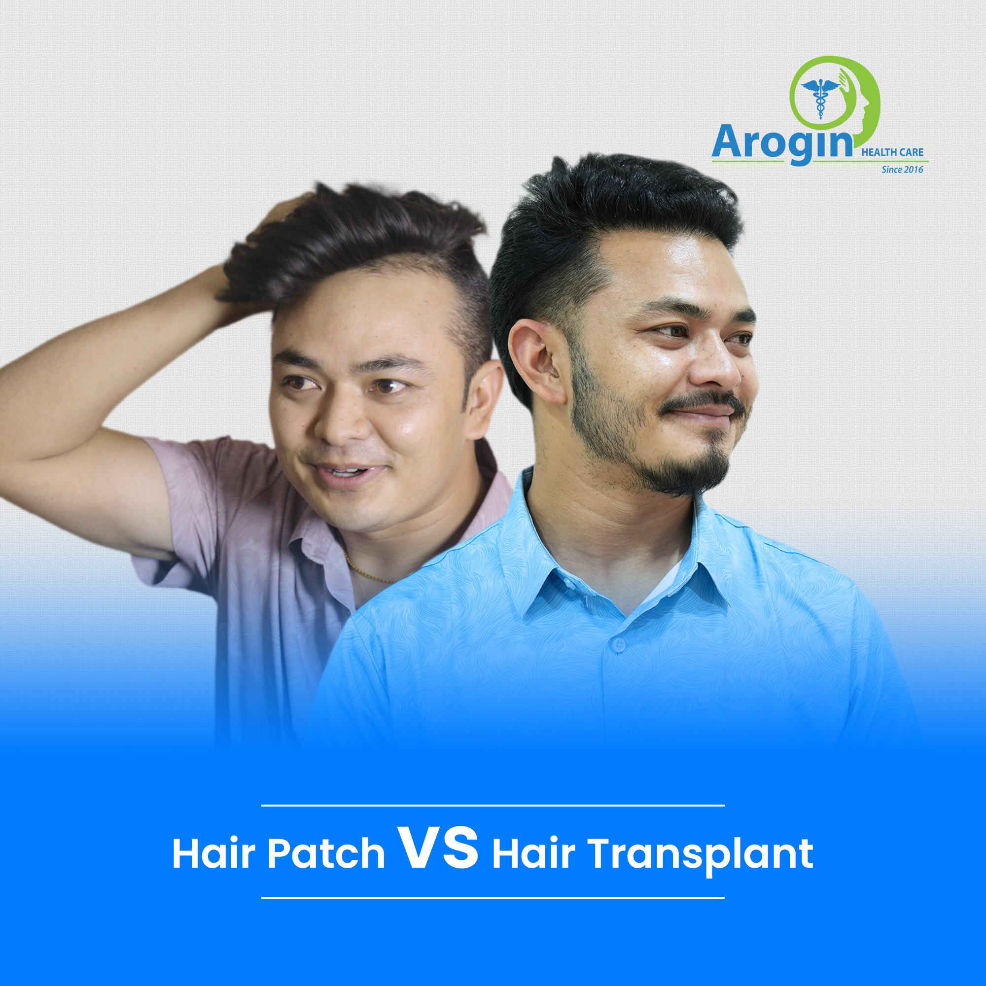 Hair Patch vs Hair Transplant: Which Is Better in Nepal?